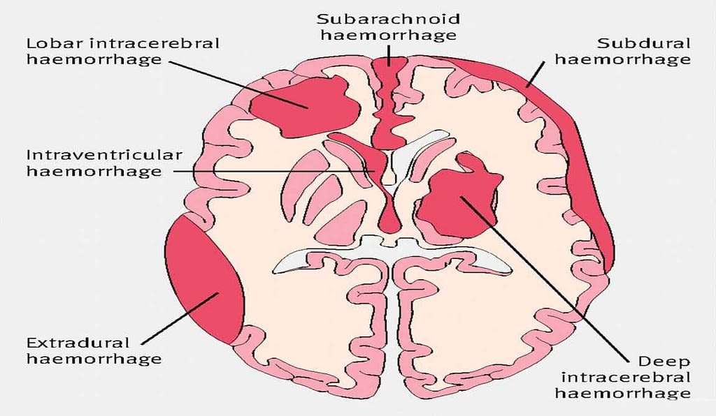 Intracranial Hemorrhage | 10 Details That You Must Know About